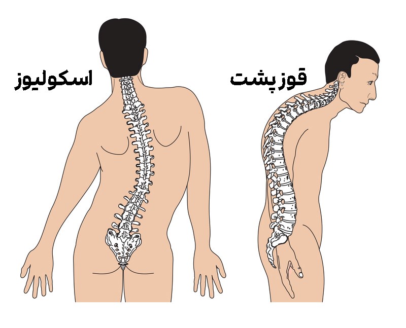 تفاوت اسکولیوز و قوز پشت